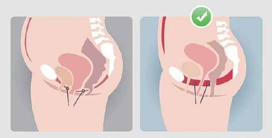 Pelvic-floor treatment scheme
