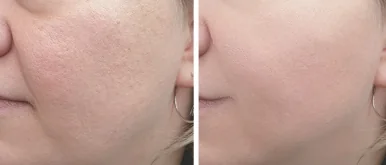 Before / after skin example