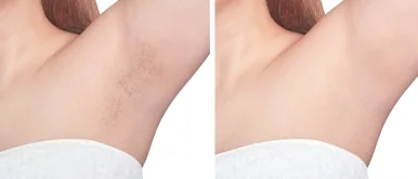 Before / after skin example