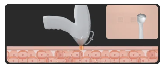 Needle and non-invasive RF heads